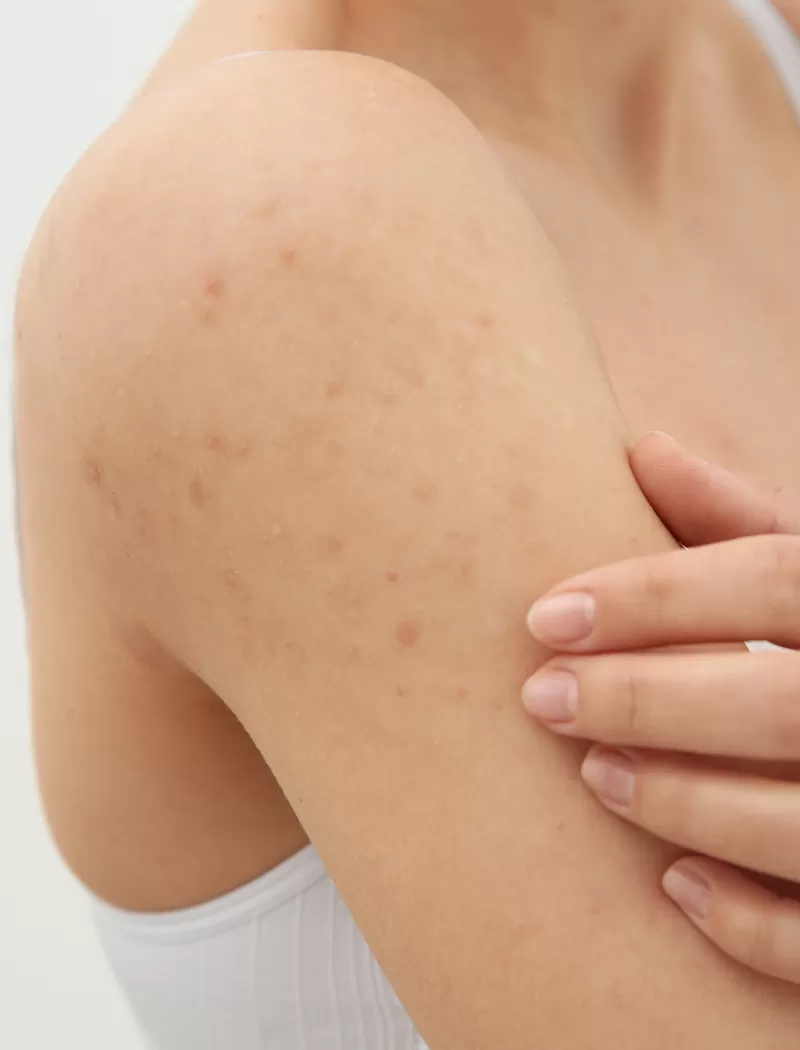 ASAP Folliculitis / KP Arm Treatment